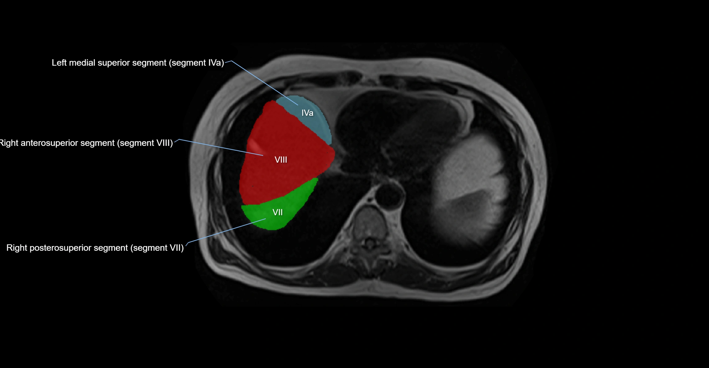 MRI  liver segments anatomy axial cross sectional 3T radiology  image-img-00001-00004.webp